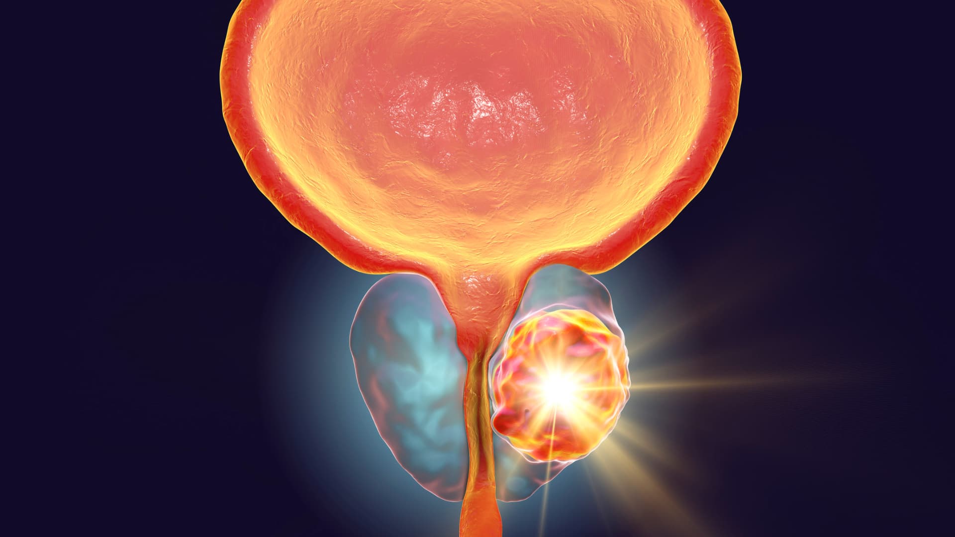 Laser Precision: The Advantages of HoLEP Laser Surgery for BPH